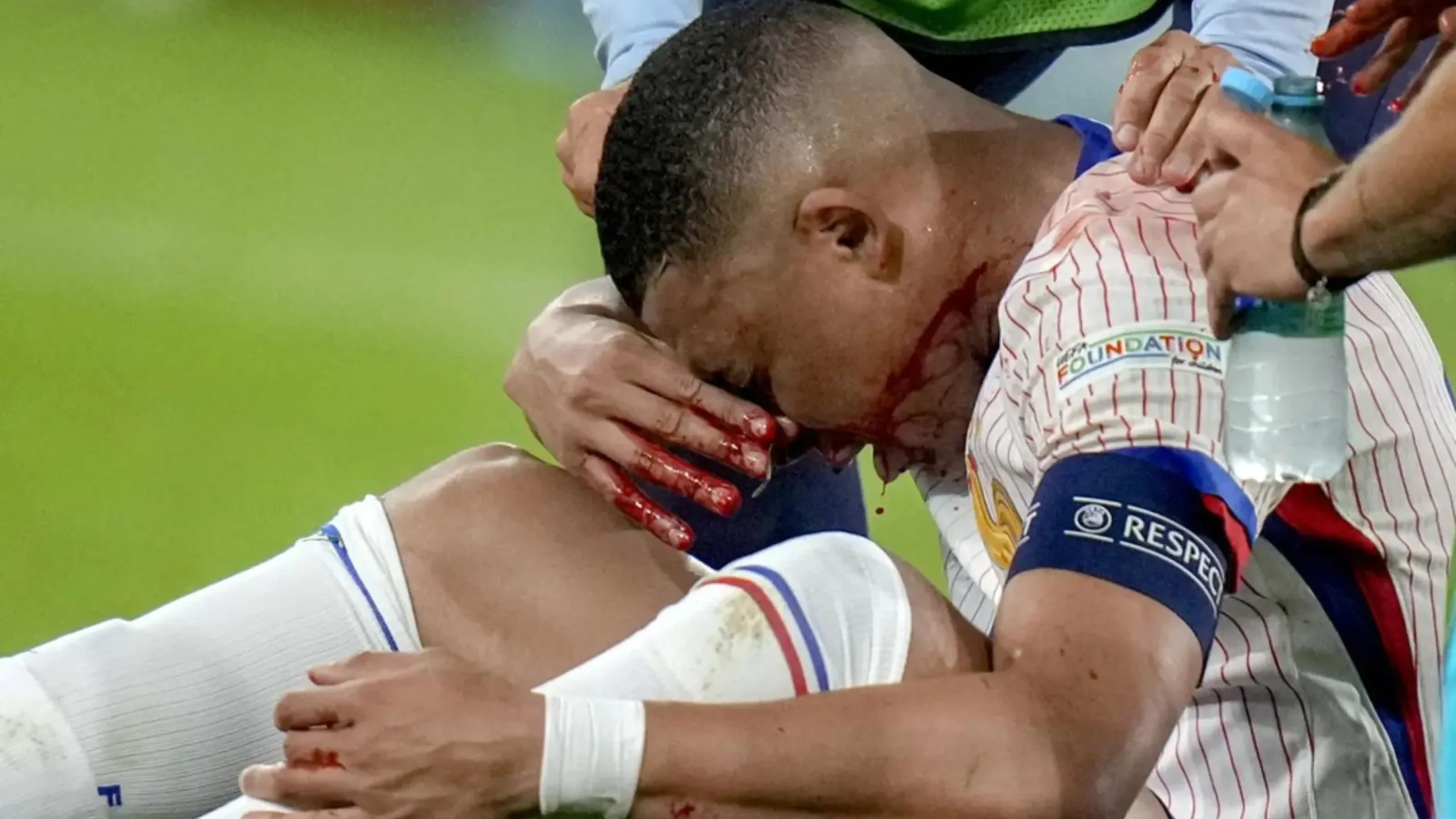 Kylian Mbappe Breaks Nose In France's Win Against Austria